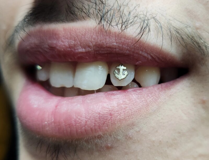 Multiple tooth gems applied at Mindcrusher Tattoo, Rogers Park Chicago